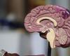 Five subtypes of Alzheimer’s discovered: ‘All require own treatment’