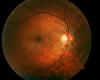 Gene medicine offers improvement in hereditary blindness