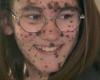 “I still feel that they think I’m strange”: Alice (12) is tired of inappropriate reactions about her birthmarks | Domestic