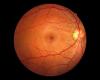 Gene experiment offers hope for treatment of hereditary blindness